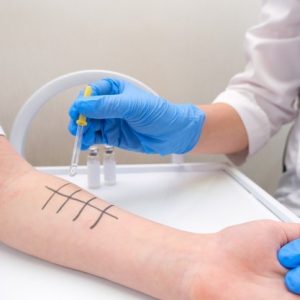 es Alergi Atau Skin Prick Test – Apa Yang Perlu Dipersiapkan?