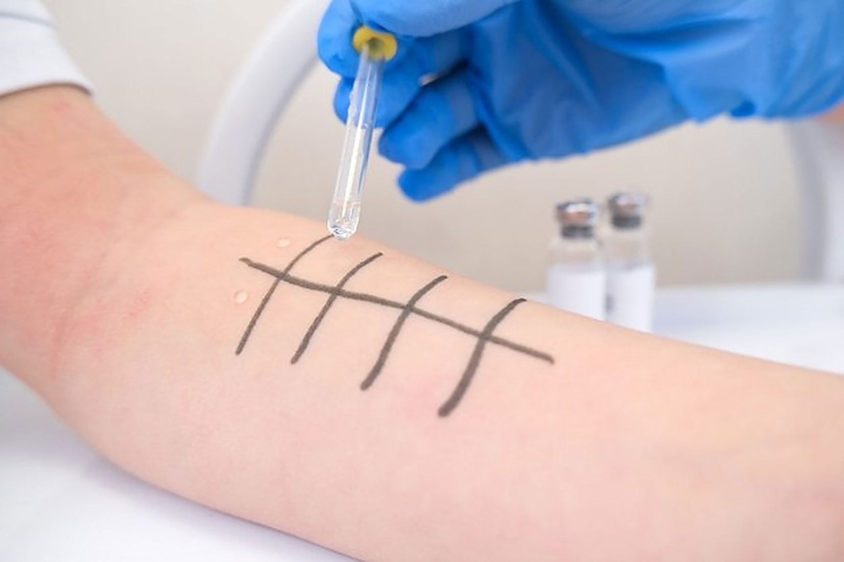 tes-alergi-skin-prick-test-klinik-tht